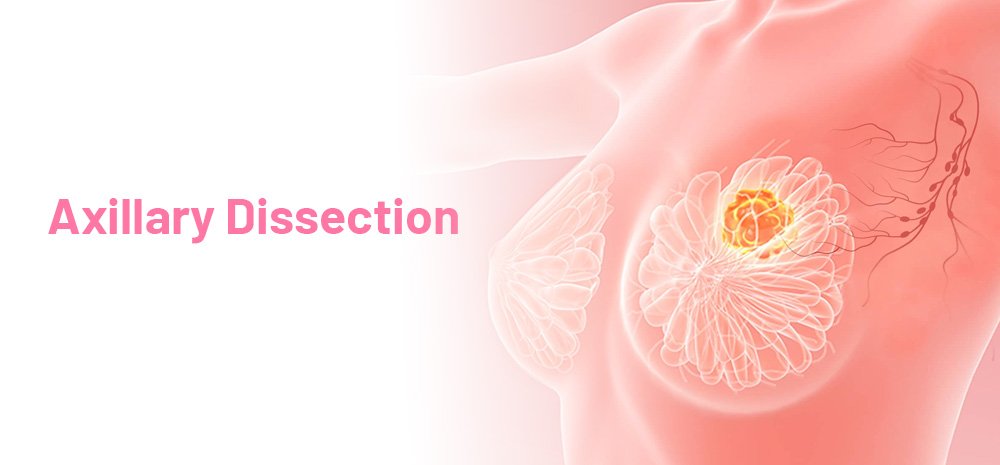 Axillary Dissection
